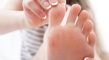 calluses on foot can be beneficial until they rip or bleed. learn how to care of them proactively