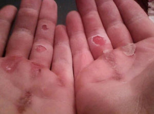 ripped callus