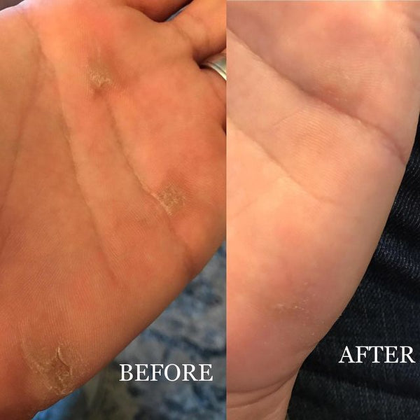 callus-healing-salve non greasy, deep healing, balm format, easy travel, natural and organic