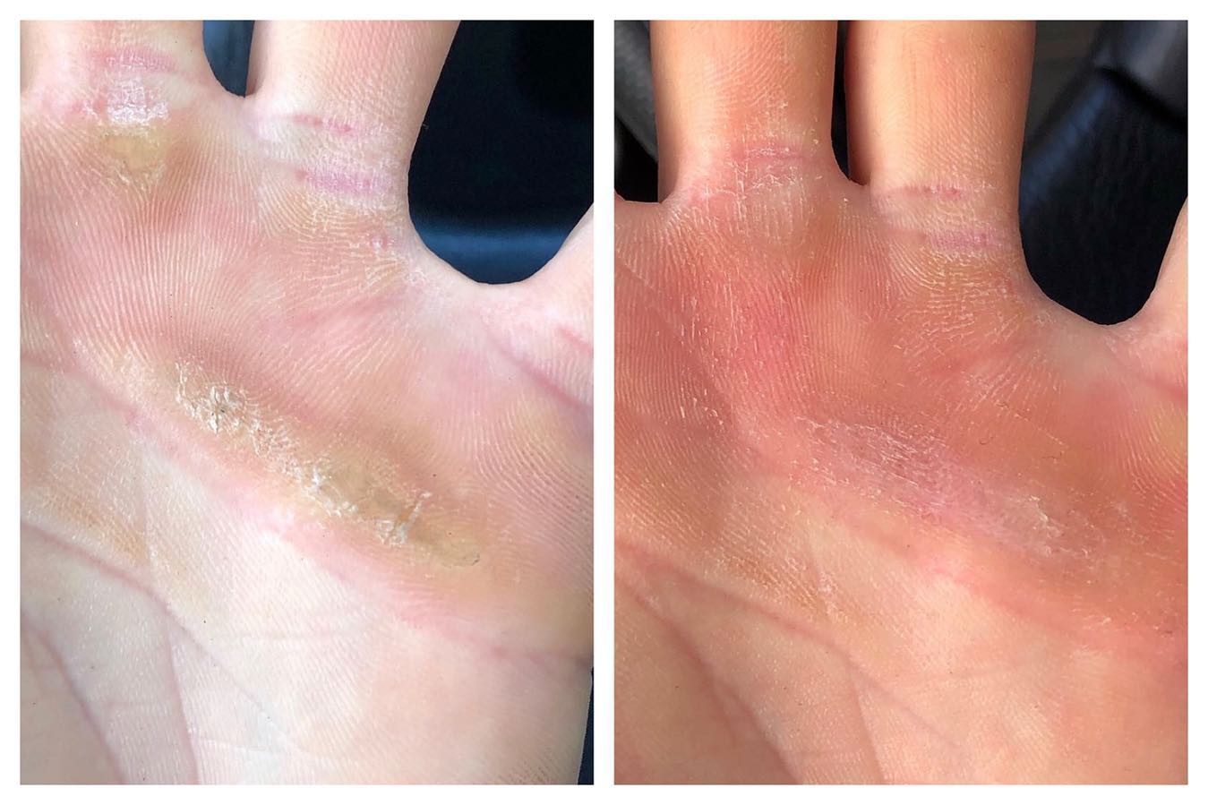 How to Care for Calluses on Your Hands from Lifting And Rowing