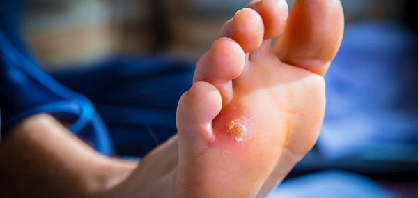 Ensure you get the best callous care solution in the market. You need callus shaving, callus soothing and moisturizing