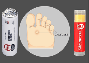 Callus performance foot callus remover tool and callus healing salve