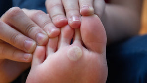 Managing Callus on feet