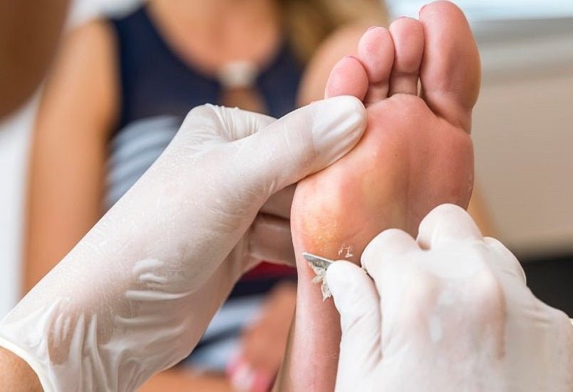Calluses Ripping How to Get Rid of Calluses on your Feet – The Ultimate Guide – Callus ...