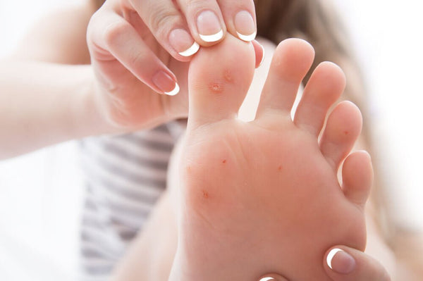 calluses on foot can be beneficial until they rip or bleed. learn how to care of them proactively