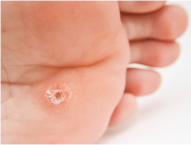How To Treat Foot Corns And Blisters For Athletes Callus Performance