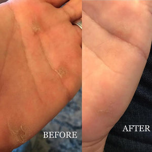 proven callus management